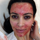 Kim Kardashian tras aplicarse un facial del vampiro hace unos años.